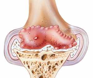 l'arthrose